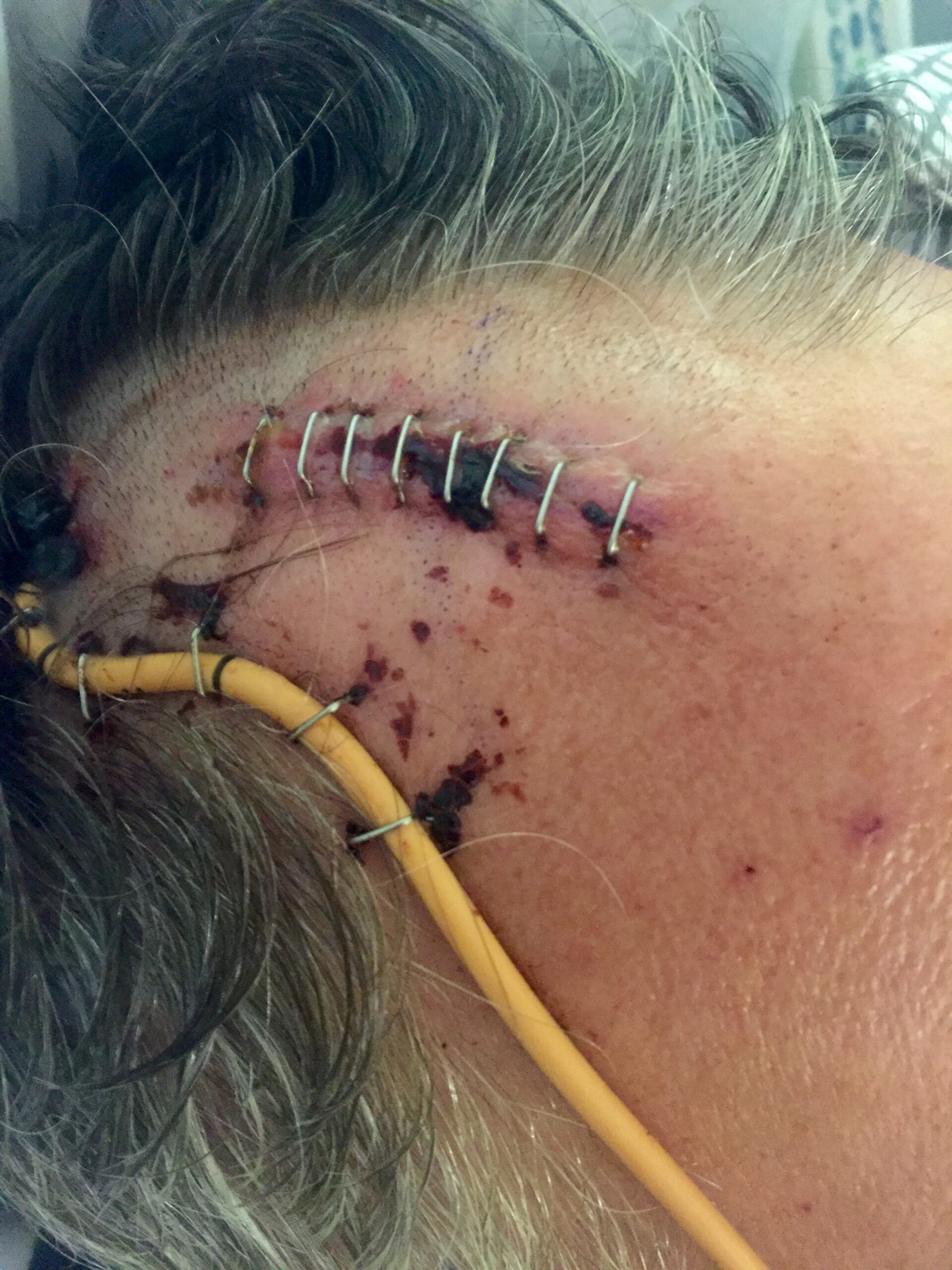 My Stroke Story
